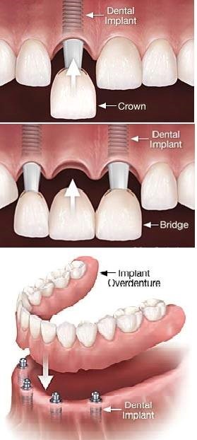 Implant Supported Dentures Vandalia MO 63382